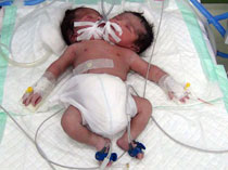 تولد نوزادی دو سر در دزفول! +عکس