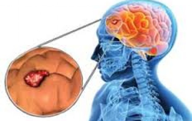 نشانه‌های تومورهای مغزی/ سردردهای خطرناک را بشناسید
