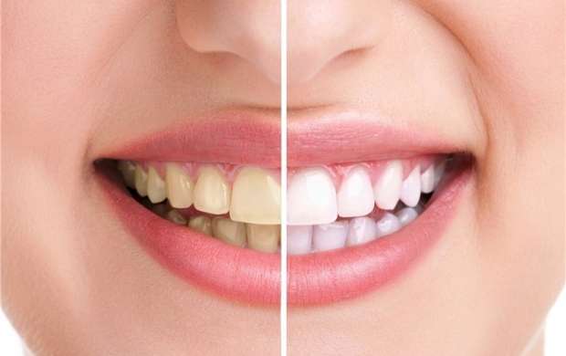 راه‌های داشتن دندان‌های سالم و زیبا
