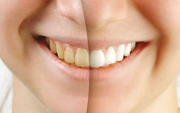 چند راهکار ساده برای سفید کردن دندان ها