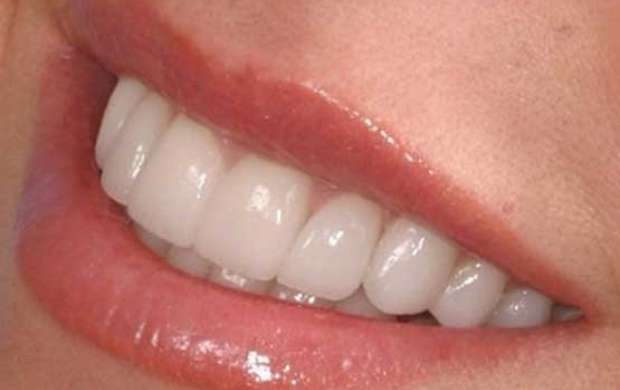 چند راهکار مفید برای از بین بردن جرم دندان