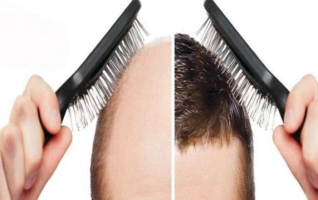 ۴۰ دلیل شایع ریزش مو + راهکار‌های درمانی
