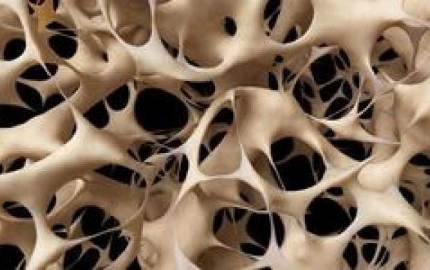 انواع پوکی استخوان کدام است؟ +راه‌های درمان