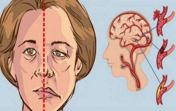 عوامل خطر سکته مغزی در زنان