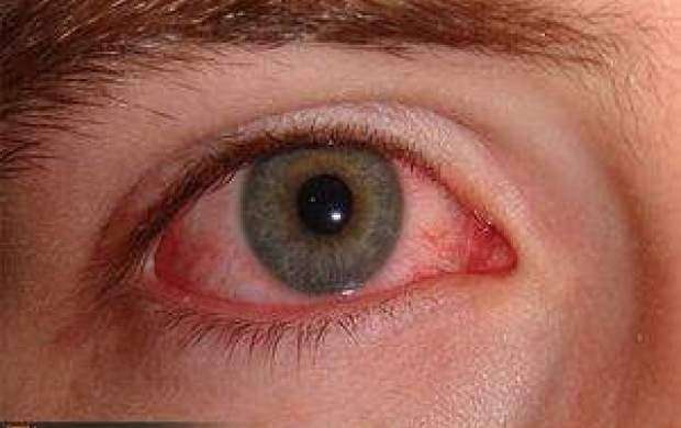علل سوزش چشم‌ها و درمان آن