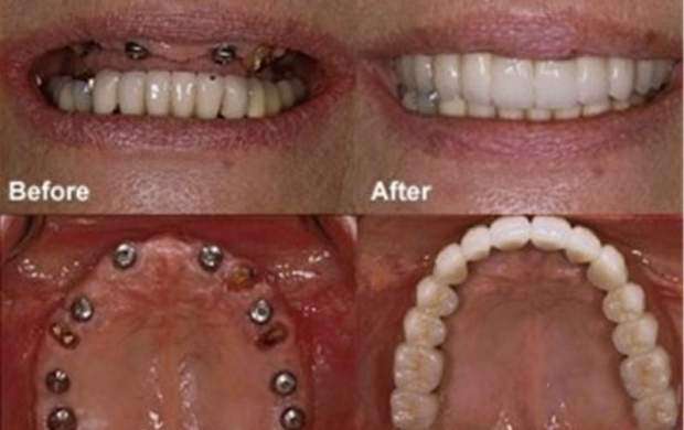 مواردی که باید درباره ایمپلنت‌ دندان بدانید