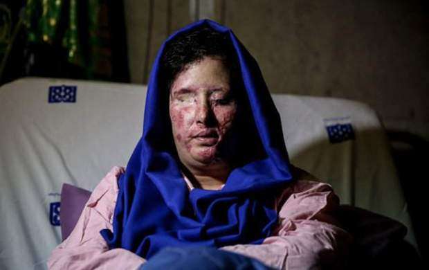 ابهام در ختم پرونده قربانیان اسیدپاشی اصفهان