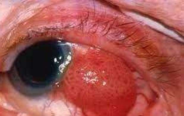 علائم سرطان چشم چیست؟