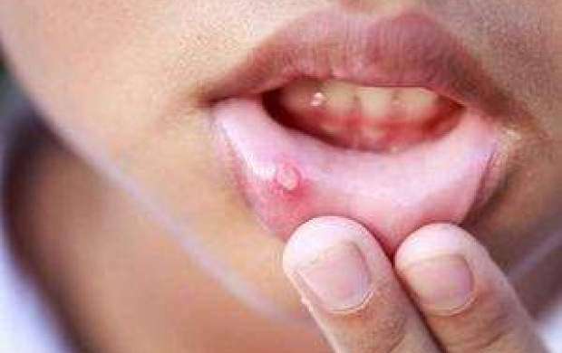 ۱۰ درمان خانگی آفت دهان