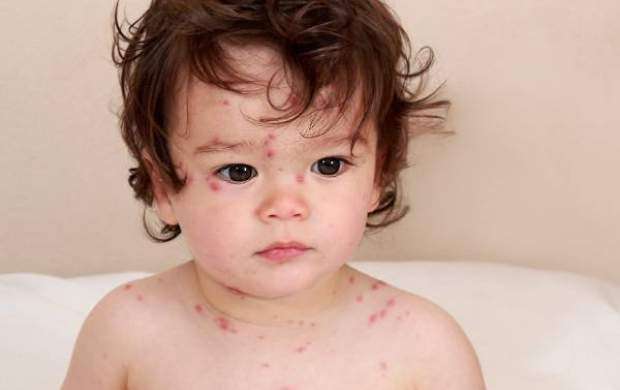 بیماری‌هایی در کودکان که درمان ندارد +عکس