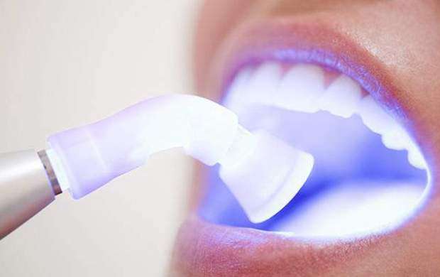 ایران سرگروه جهانی لیزرهای دندان پزشکی