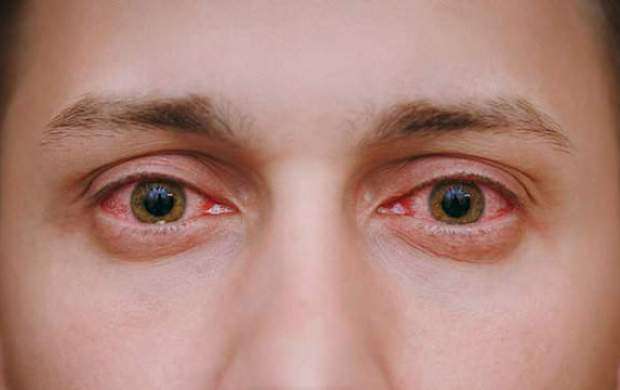 ۵ دلیل احتمالی قرمزی چشم‌ها