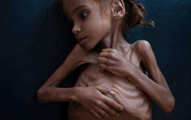 ۱۰ میلیون یمنی از گرسنگی شدید رنج می برند