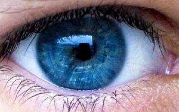 تشخیص آلزایمر با مشاهده عروق خونی چشم