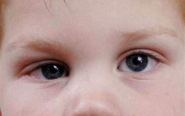 کدام کودکان به تنبلی چشم دچار می‌شوند؟