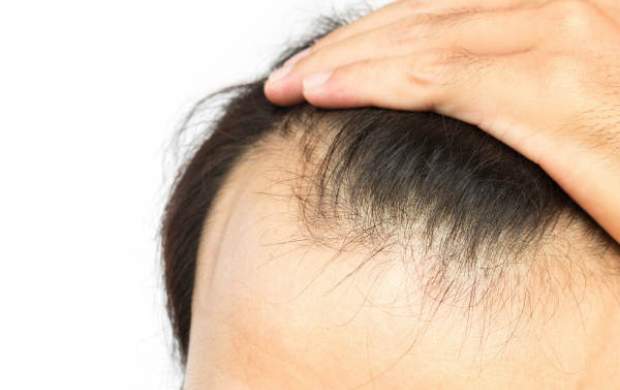 جدیدترین روشهای جلوگیری از ریزش موی سر