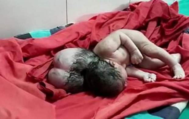 نوزادی که با ۳ سر در هند به دنیا آمد