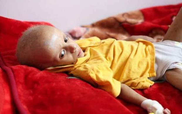 هر ۱۰ دقیقه یک کودک یمنی می‌میرد