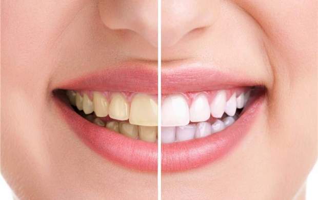 علت‌"پوسیدگی دندان" چیست؟