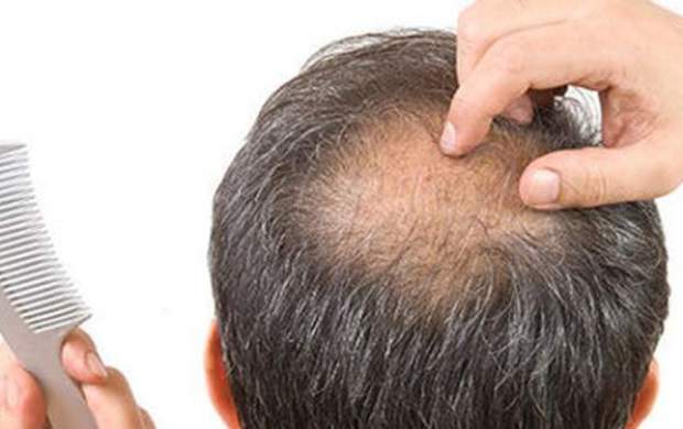 علل اصلی«ریزش مو» چیست؟