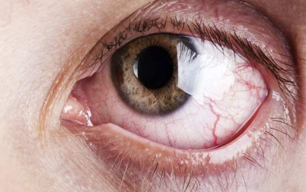 عارضه‌ای چشمی که بینایی شما را نشانه می‌رود