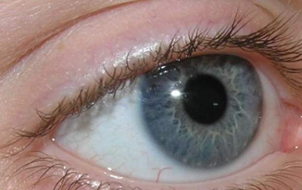 انحراف چشم کودکان چگونه درمان می‌شود؟