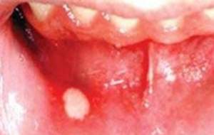 «عفونت دندان» باعث آسیب به چشم و مغز می‌شود
