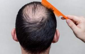 آیا بیماران کرونایی ریزش مو می گیرند؟