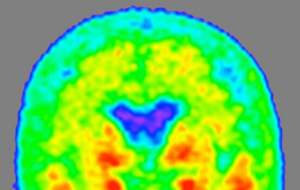 کشف سریع آلزایمر با بررسی مایع نخاعی ممکن شد