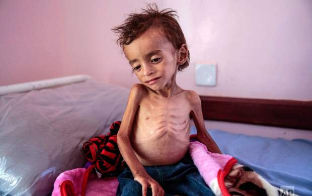 ۴۰۰ هزار کودک زیر ۵ سال یمنی در آستانه مرگ