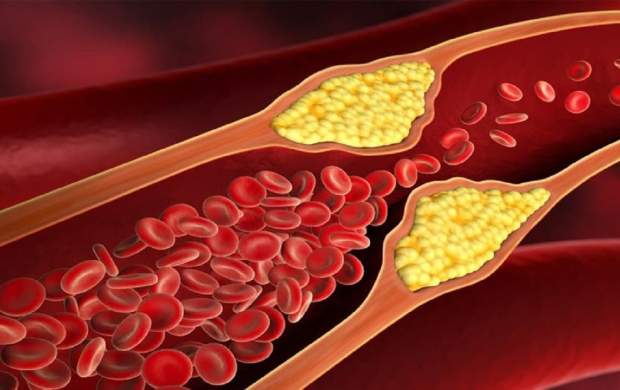 راهکار‌هایی برای کاهش سطح «کلسترول بد خون»