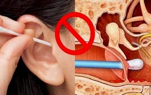 چرا نباید از گوش‌ پاک‌کن استفاده کنیم؟