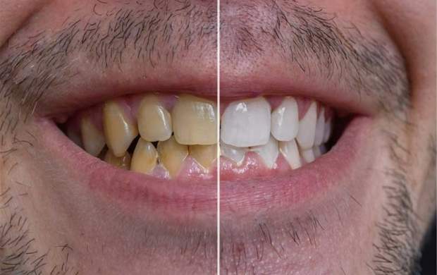 ۱۴ راه فوری و طبیعی «سفید کردن دندان‌ها»