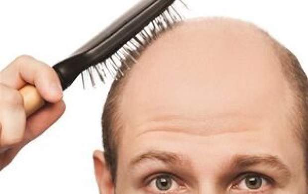 آیا ریزش مو از عوارض کرونا است؟