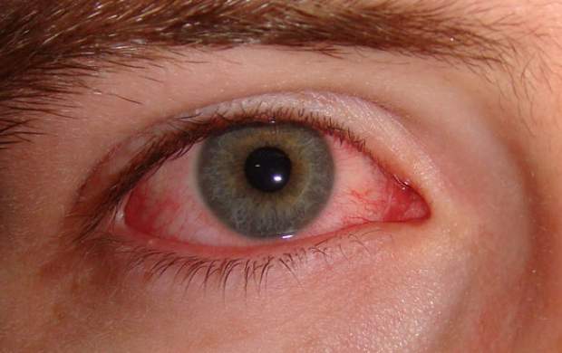 قرمزی چشم دلیل چه بیماری‌هایی است؟