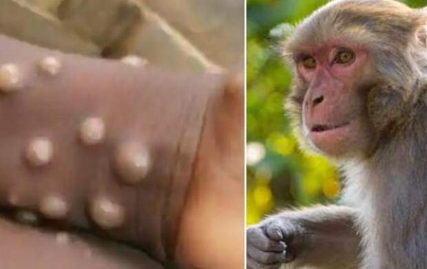 شناسایی مبتلا به آبله میمون در همسایگی ایران