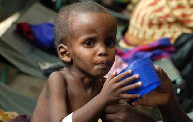 سوءتغذیه مرگبار کودکان در سومالی