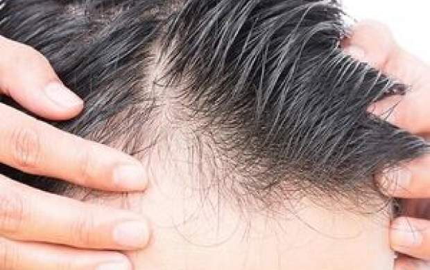 چه چیزی باعث ریزش مو در مردان می‌شود؟