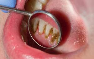 عوارض جرم روی دندان بر لثه