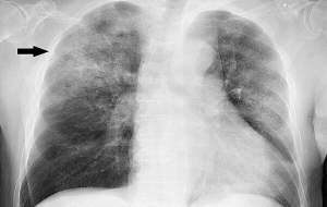 این بیماری حاد تنفسی را در فصل سرما جدی بگیرید