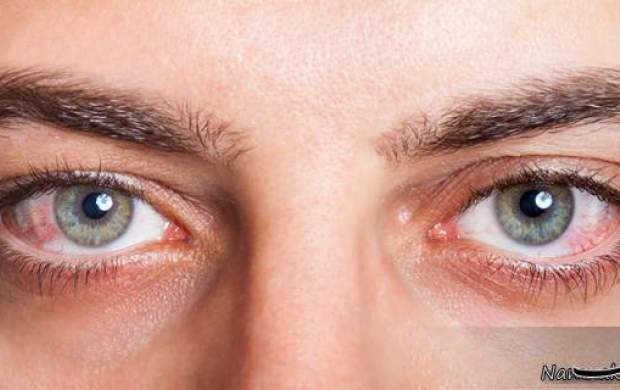 خشکی چشم چگونه درمان می‌شود؟