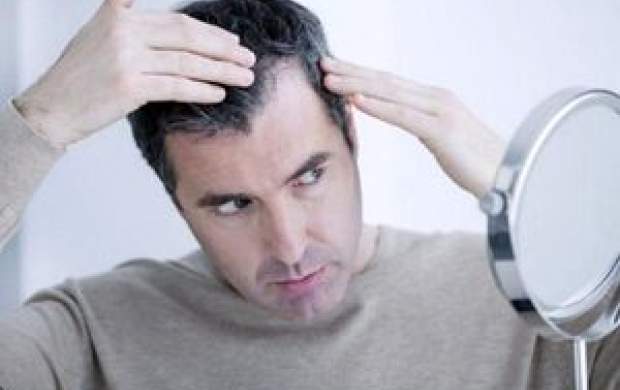 آنچه باید از ریزش موی سکه ای بدانید