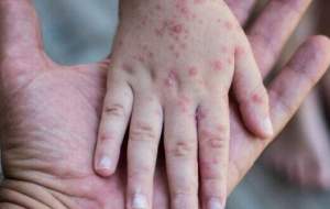 سرخک و سرخجه در ایران ریشه‌کن شد