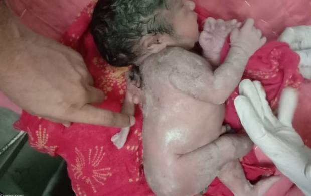 فیلم/ تولد یک نوزاد در هند با سه دست!