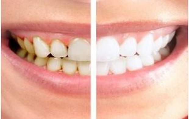 چگونه در خانه دندان‌های زرد را سفید کنیم؟