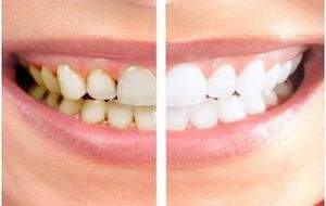 علت زردی دندان‌ها چیست؟