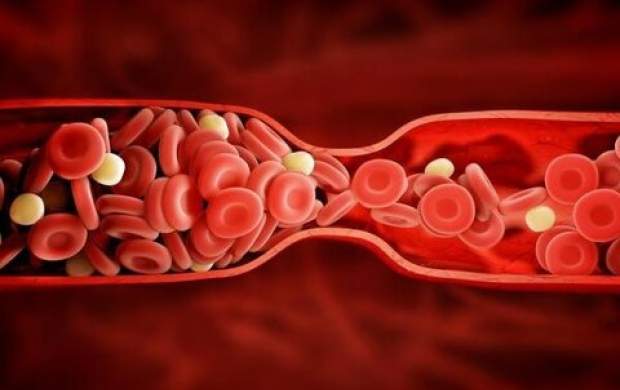 رابطه پلاک‌ های خونی با حمله قلبی چیست؟