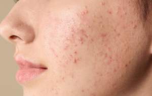 چرا مدام جوش می‌زنیم؟