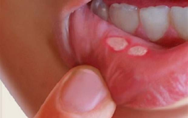 درمان آفت دهان با چند راهکار طب سنتی