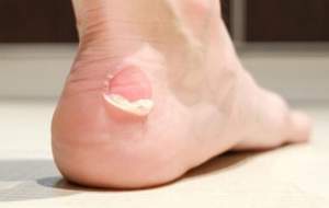 چرا تاول روی پا دردناک است؟